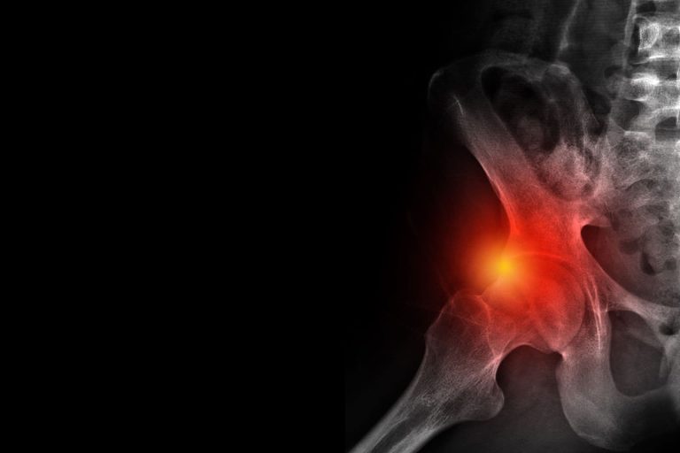 A csípő ütközéses szindrómája (femur acetabulum)