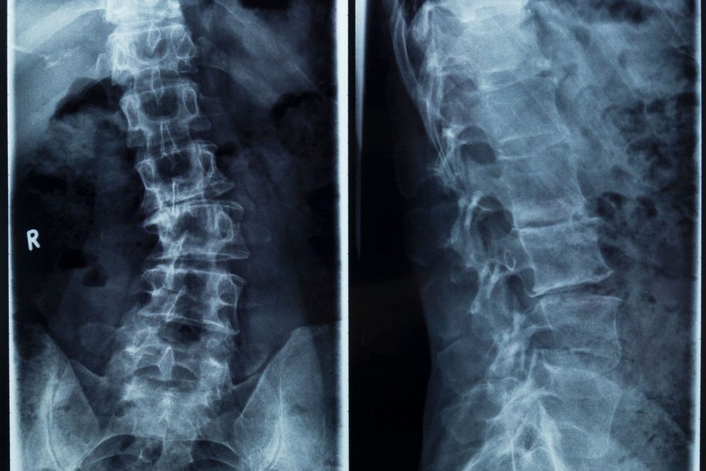 Gerincferdülés (scoliosis)