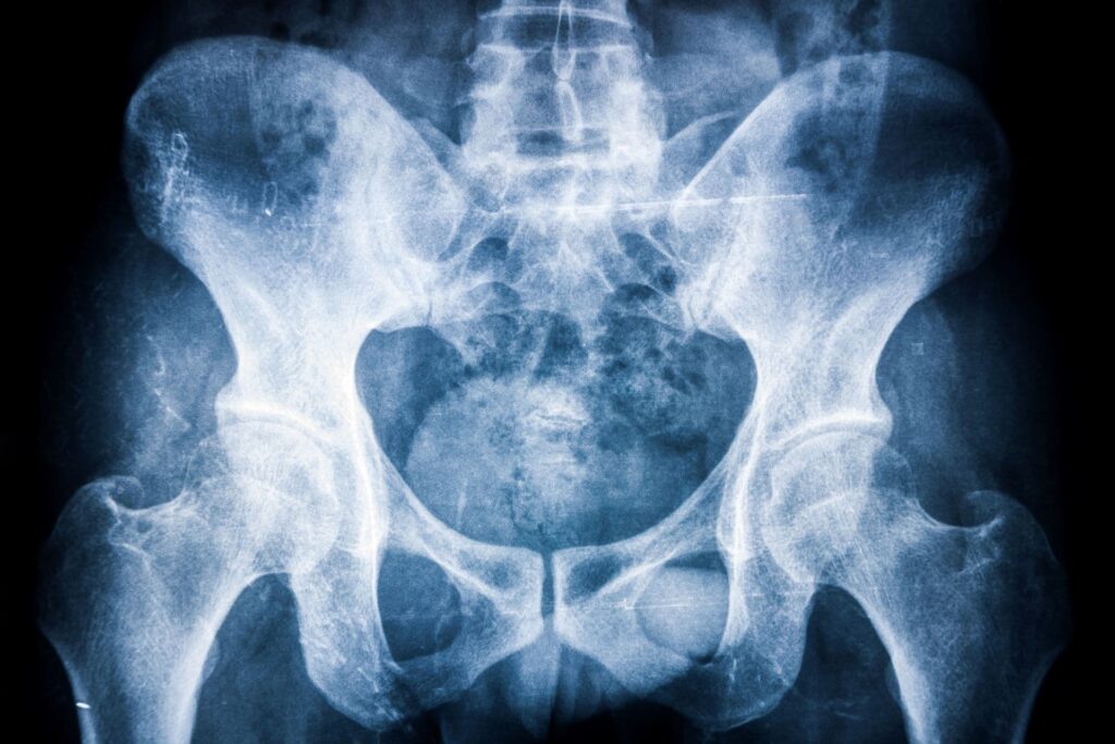 Bechterew-kór (spondylitis ankylopoetica)