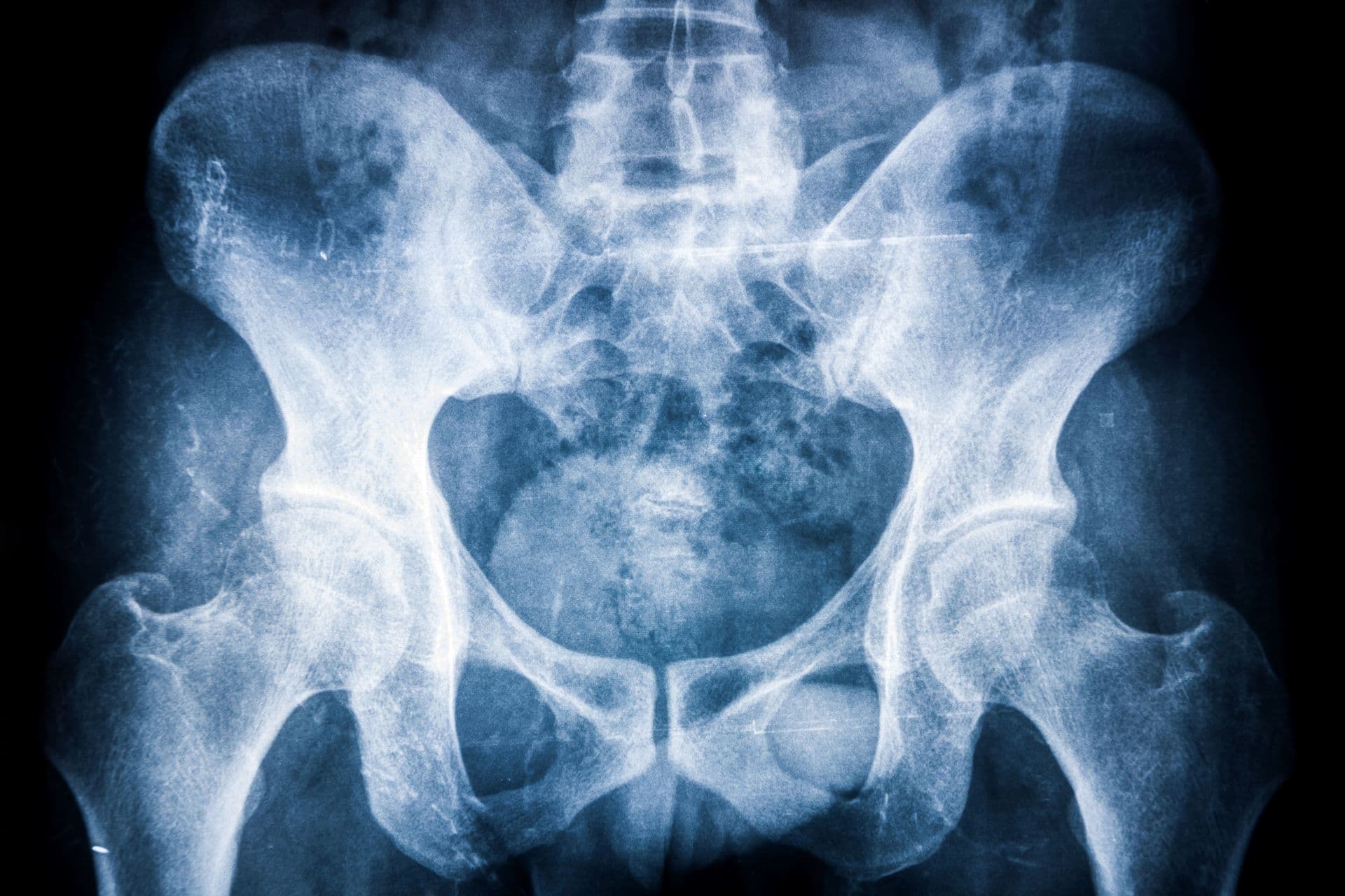 Bechterew-kór (spondylitis ankylopoetica)